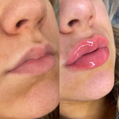 Extreme Lip Plumper